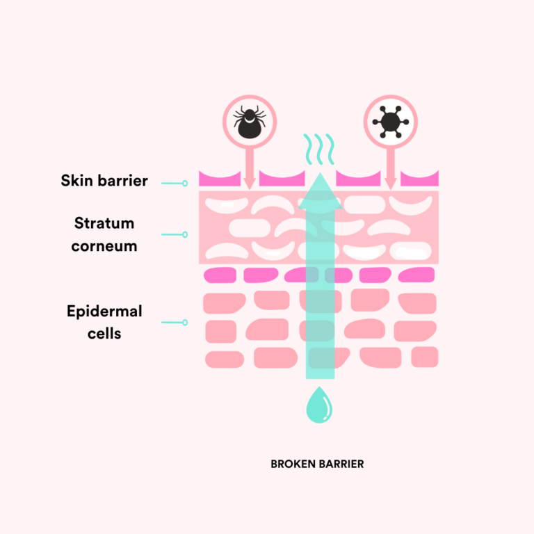 A broken skin barrier with high transepidermal water loss. Water evaporates through the epidermal layer and allows toxins in.
